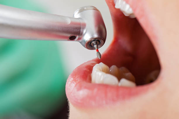 Best Emergency Dental Care for Broken or Chipped Teeth in Osgood, IN